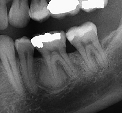 <p>What is this lesion?</p>