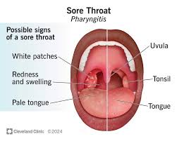 <p>red throat</p><p>irritation</p>