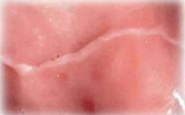 <p><strong><u>Linea alba</u></strong></p><p class="has-focus">Biting irritation / sucking habit</p><p class="has-focus">May be associated with leukoedema</p><p class="has-focus"></p><p class="has-focus is-empty"><strong>No Treatment </strong>- may spontaneously regress</p><p class="has-focus"></p><p class="has-focus is-empty"><em>DD - Cinnamon contact stomatitis, scaar formation, Cheek biting keratosis</em></p>