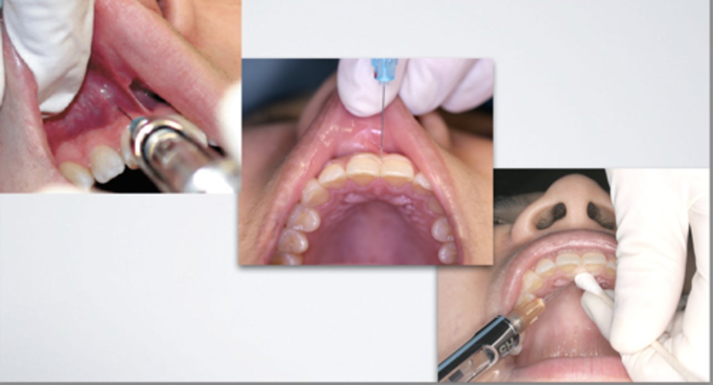 <p>Which injection technique? (be specific)</p>