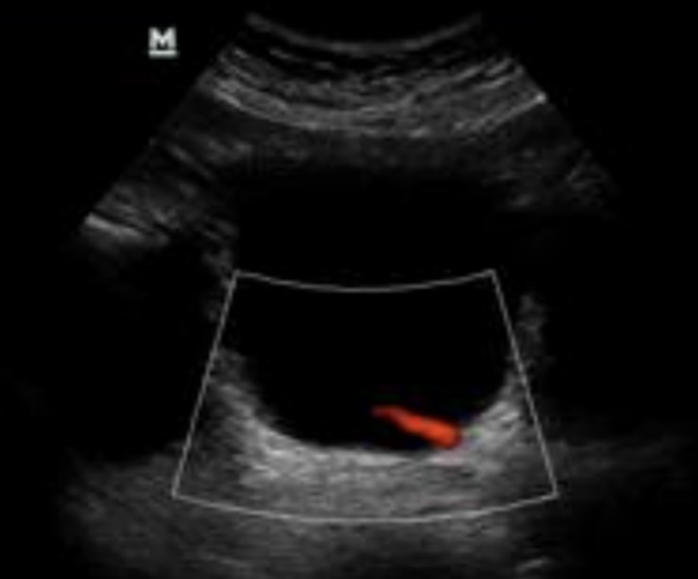 <p>This urine jet is coming from what ureter?</p>