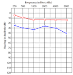 <p>What patient is this? What kind of hearing loss do they have??</p>
