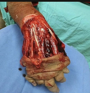 <p>degloving accidents</p>