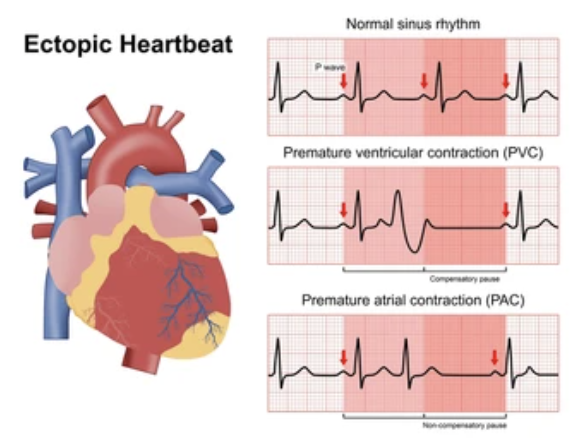 <ul><li><p>When a single beat arises from an ectopic focus (a site outside of the SA node) within the conduction system&nbsp;</p></li><li><p>Common use to suggest that the site became irritable and overrode the sinus node&nbsp;</p></li></ul><p></p>