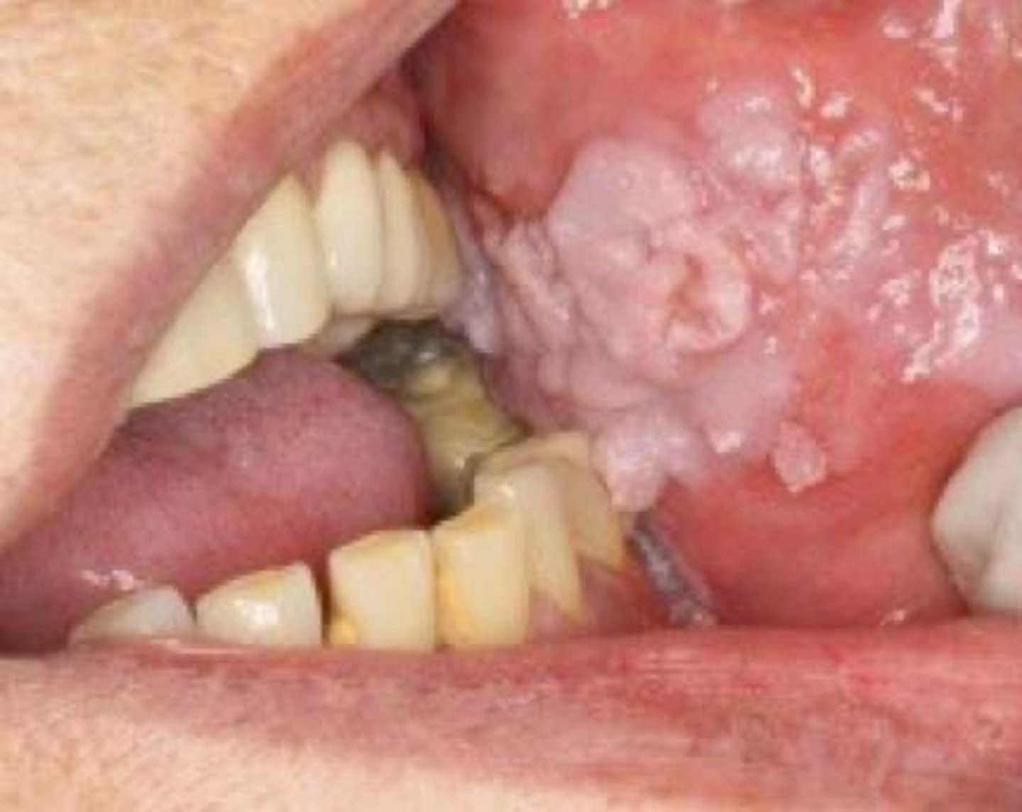 <p>A slow-growing, thick, white, warty lesion on the buccal mucosa of an older adult who uses smokeless tobacco is most likely:</p>