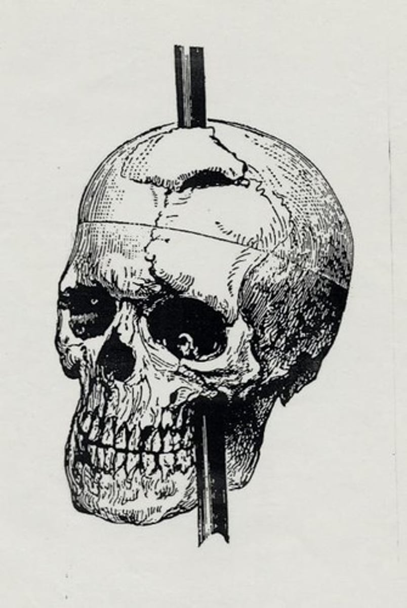 <p>Case study illustrating frontal lobe's role in personality.</p>