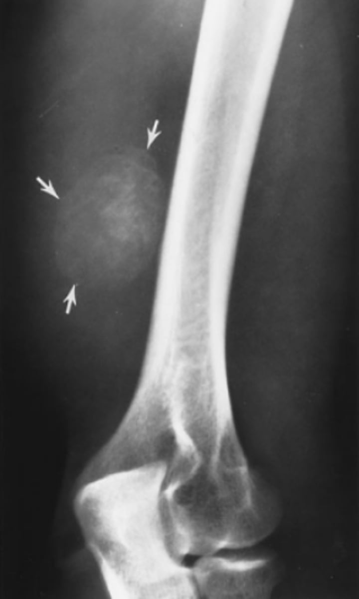 <p>What should you do about the calcified lump in the</p><p>patient's arm in Case 6-8 (Figure 6-21)?</p><p>A. Needle biopsy</p><p>B. Open excisional biopsy</p><p>C. Reassure the patient</p><p>D. Bone scan</p>