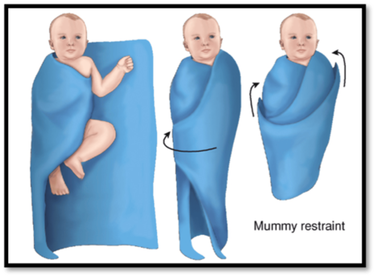 <p>A blanket or sheet wrapped in a special way to enclose a child's body to prevent movement during a procedure</p>