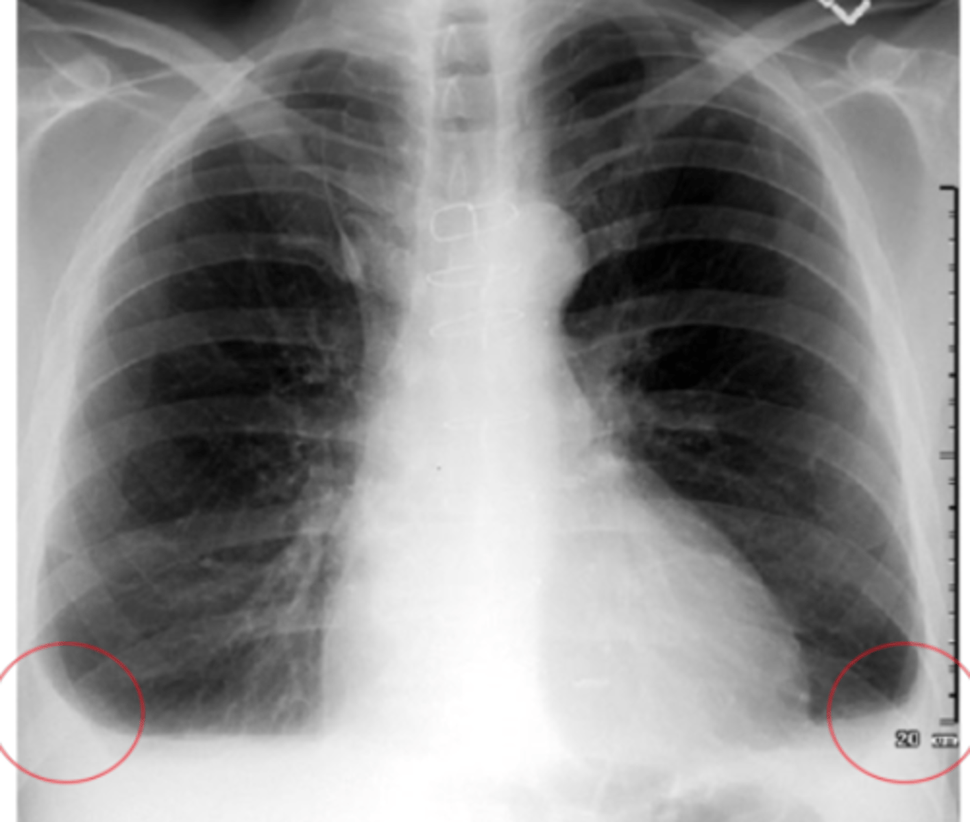 <p>Indicates effusion but not too severe</p>