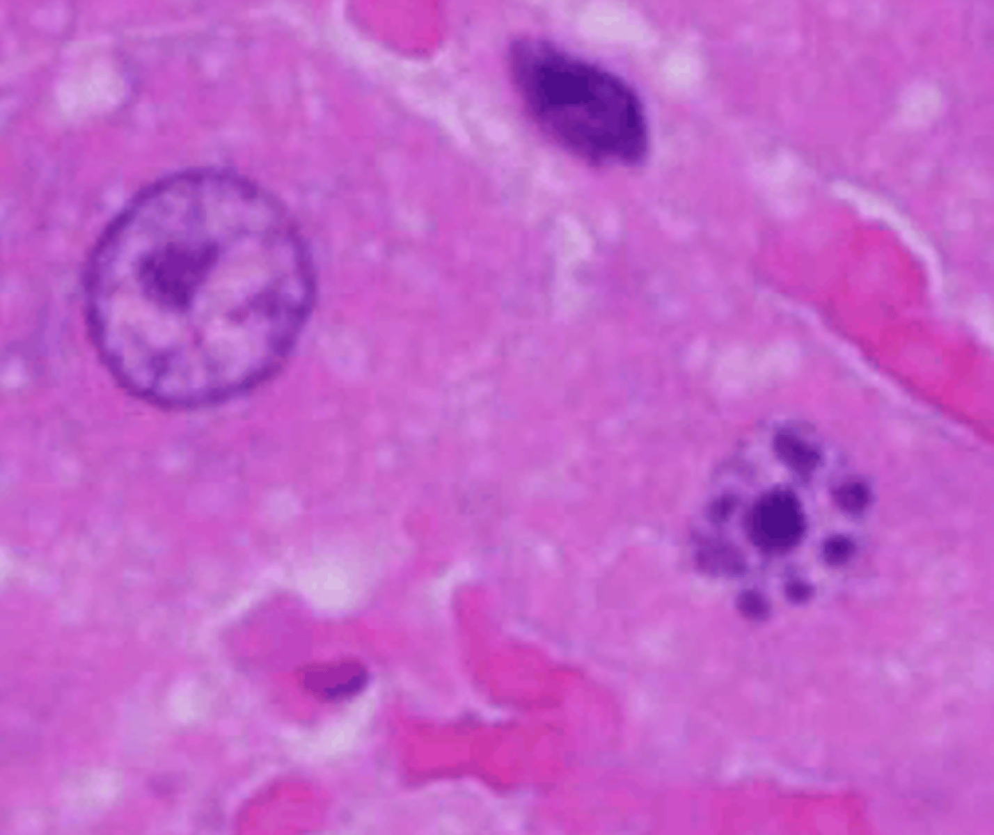 <p>This is an image showing a cell undergoing necrosis. What type of nuclear changes are occuring?</p>