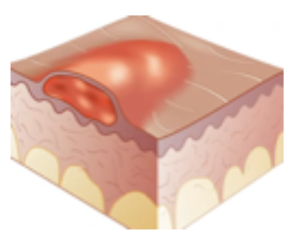 <p>Primary Skin Lesion</p><ul><li><p>Rises from <strong>allergic reactions </strong></p><ul><li><p>E.g., urticaria/Hives</p></li></ul></li><li><p><strong>No fluid</strong> and <strong>not</strong> a <strong>raised lesion</strong></p></li><li><p><strong>Warm</strong> to touch</p></li></ul><p></p>