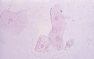 Squamous epithelial cells stained with KOVA