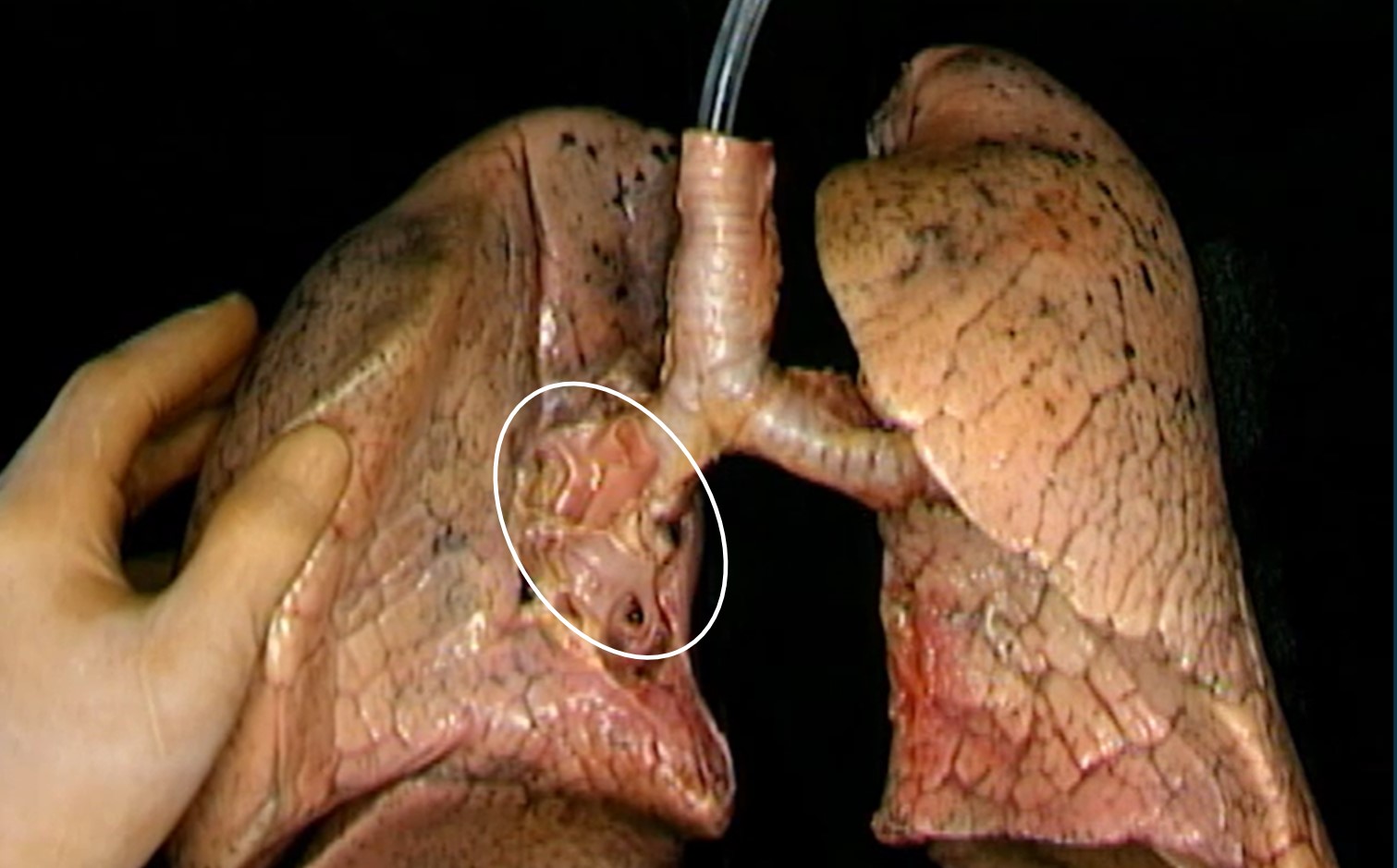 <p>deel van long t.h.v. de mediale zijde die de bronchus pulmonalis …</p>