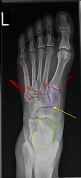<p>MAIN GOAL:</p><ul><li><p>open med-mid cuneiform joint</p></li><li><p>1/3 talus head free of SI</p></li></ul><p>SUPPORTING</p><ul><li><p>open IMT joint 1-2 free of SI</p></li><li><p>2-5 MT somewhat SI</p></li><li><p>MT heads clear of SI</p></li></ul><p></p>