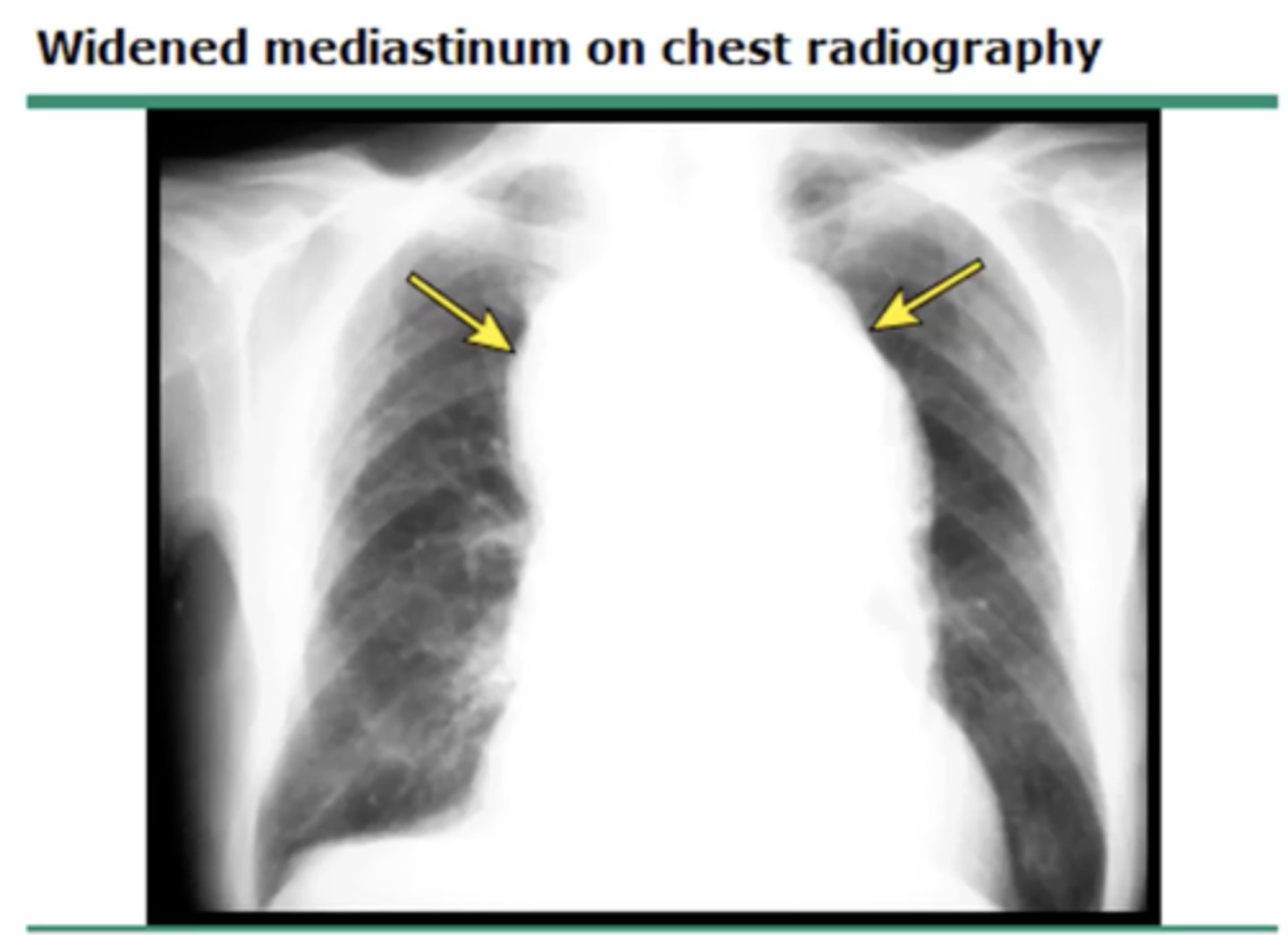 <p>(evaluating AP CXR) widened mediastinum</p>