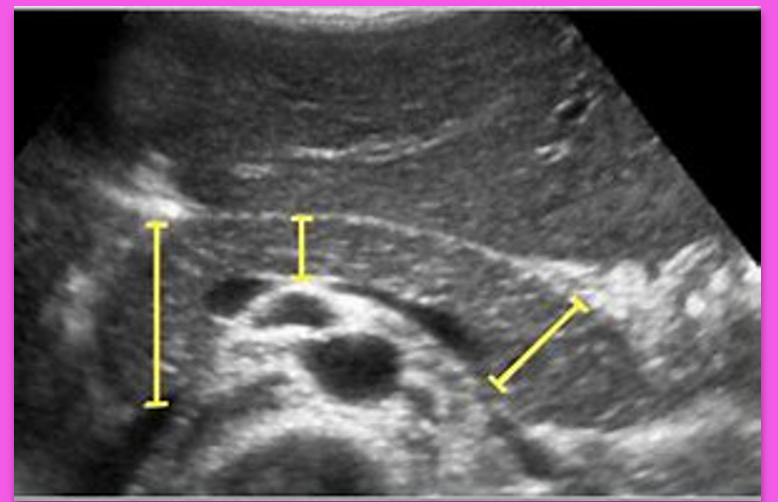 <p>Normal measurements of the Pancreas are:</p><p>Head: ____ cm </p><p>Neck: ____ cm </p><p>Tail: _____ cm </p>