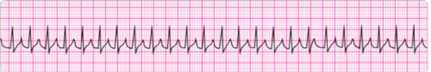 <p>A 35-year-old woman presents to the emergency department with a chief compliant of palpitations. She has no chest discomfort, shortness of breath, or light-headedness. Which of the following is indicated first?</p><p>1. Perform vagal maneuvers.</p><p>2. Give adenosine 12 mg IV slow push (over 1 to 2 minutes).</p><p>3. Give metoprolol 5 mg IV and repeat if necessary.</p><p>4. Give adenosine 3 mg IV bolus.</p>