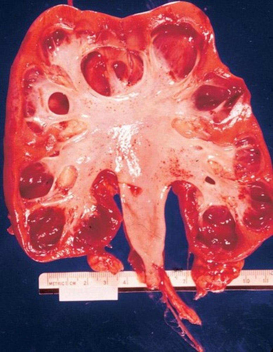 <p>Autosomal dominant; fairly common (1 in 500-1,000 people); does not usually become symptomatic until after age 30</p>