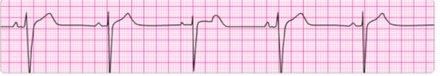 <p>Identify the rhythm.</p>