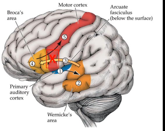 <p>_____ ____ is impaired repetition of words only and is normally caused by damage to ____ ______ </p>