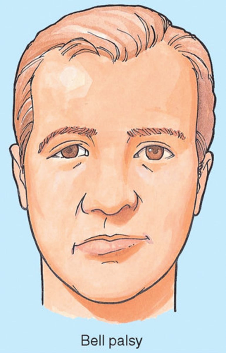 <p>Sudden one-sided facial paralysis. May include: Forehead, cheek, nose, or jaw; common after infection OR in 3rd trimester (med: acyclovir)</p>
