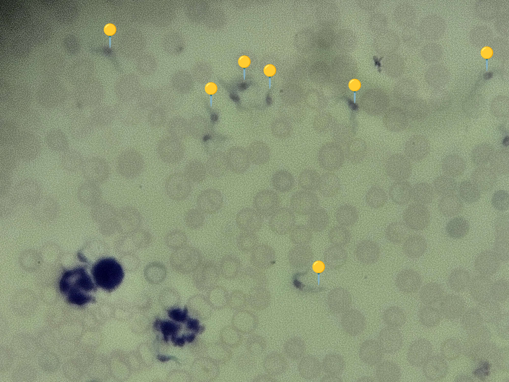 <p><span data-name="worm" data-type="emoji">🪱</span><span data-name="flag_us" data-type="emoji">🇺🇸</span><span><span> </span></span><strong><em>Trypanosoma cruzi </em></strong><sub>(Trofozoit)</sub></p><p></p><p></p><p><span>🟡</span> - jest mniejszy, słabiej wybarwiony, mniej liczebny i mniej wygięty niż <em>Trypanosoma gambiense</em>; należy zwracać uwagę na ciemniej zarysowane jądra komórkowe.</p><p></p><p></p><p><span>😷❓ </span><strong>Parazytoza:</strong><em> Trypanosomoza amerykańska/Choroba Chagasa</em></p>