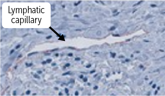 <p>Lymphatic capillaries </p><ul><li><p>has a thin, simple squamous endothelium overlying a discontinuous basement membrane, do not contain a muscular layer, and have a poorly defined adventitia.</p></li><li><p>The wall is only one cell layer thick, much like the vascular capillaries</p></li></ul><p></p>