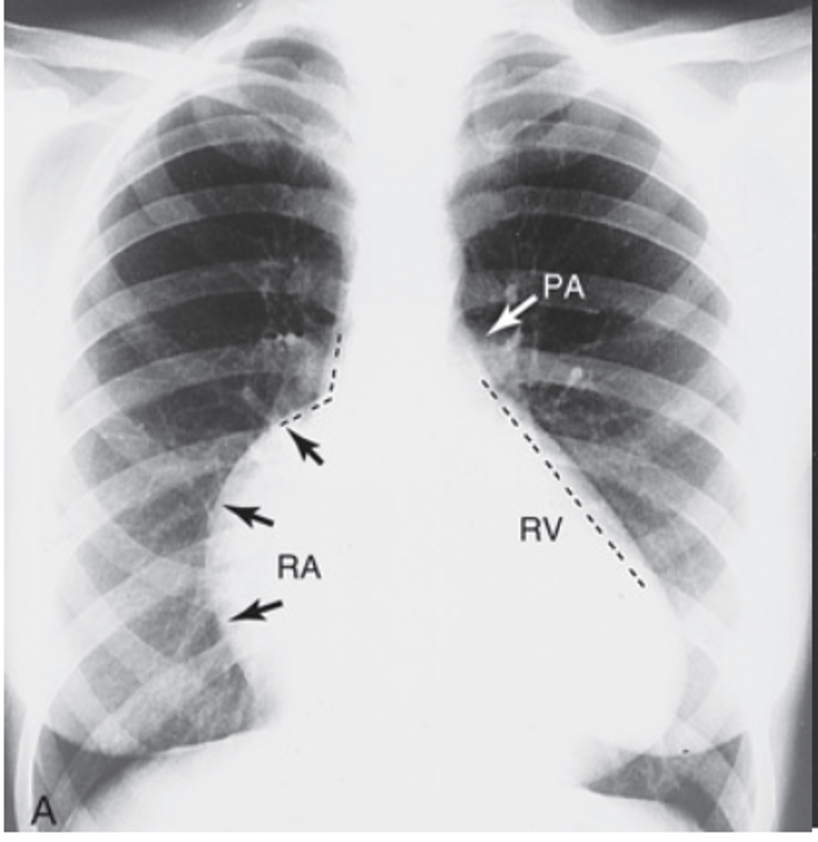 <p>- giant right atrium appears</p><p>- shoulder along the right side</p><p>- very small pulmonary artery</p>