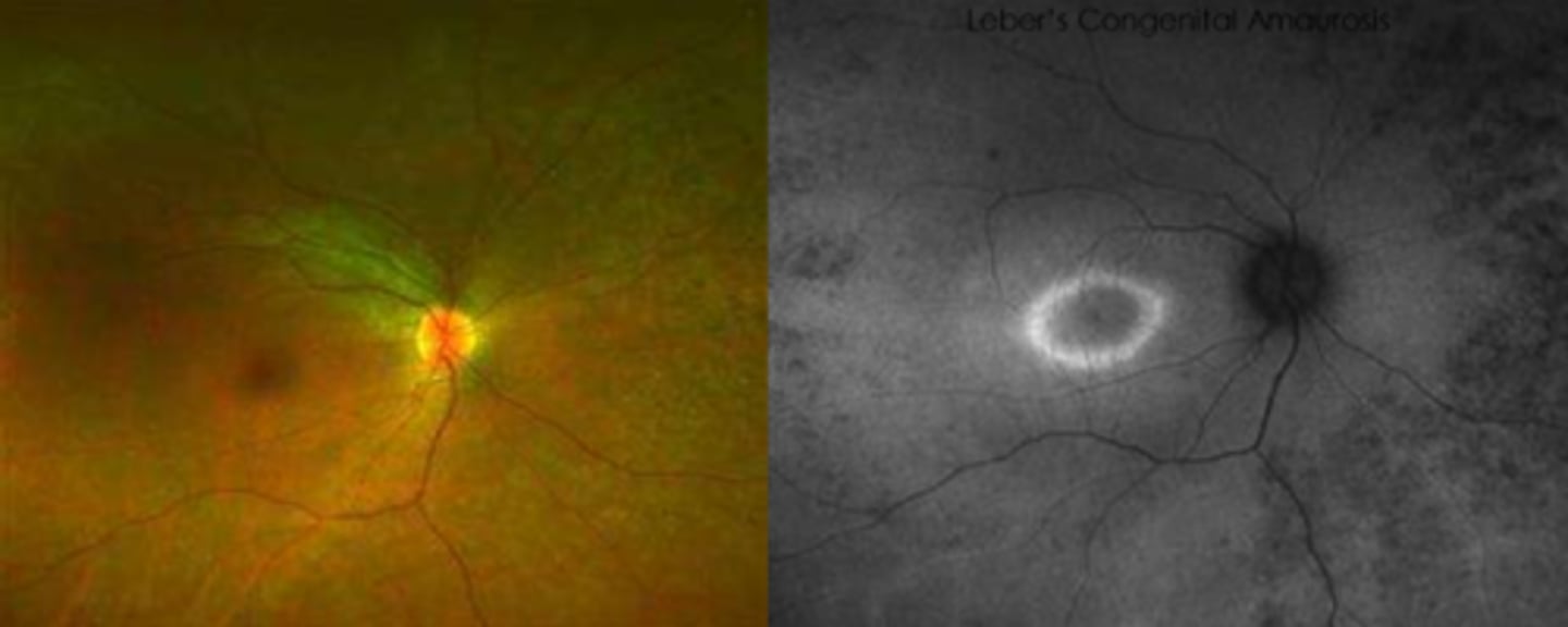 <p>attenuated BV</p><p>peripheral pigmentary changes</p><p>FAF = peripheral hypopigmented spots and a ring of hyperfluorescence surrounding the fovea</p>