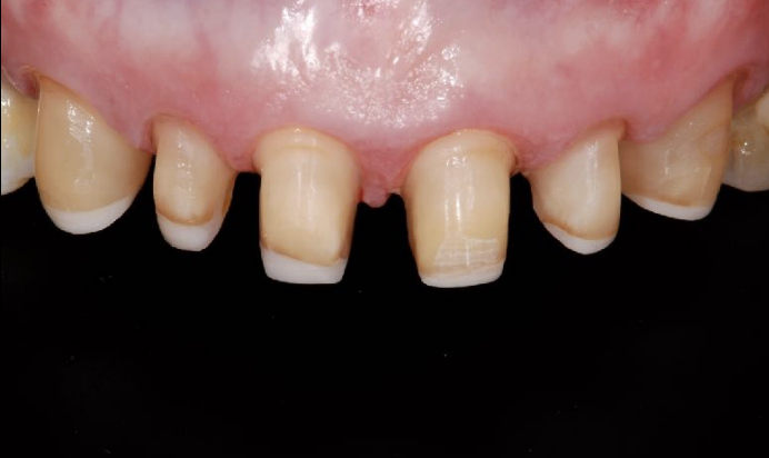 <p>if the anterior tooth substrate color is dark, and your pt wants “hollywood white” which material would you use for a full coverage all ceramic crown </p>