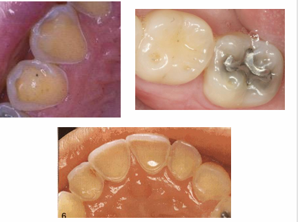 <p>-broad concavities on cusp tips (mandibular molars)</p><p>-smooth silky glazed appearance</p><p>-increased incisal translucency</p><p>-”raised” amalgam restorations (enamel wears away but amalgam does not)</p><p>-loss of surface anatomy in young children</p><p>-hypersensitivity</p>