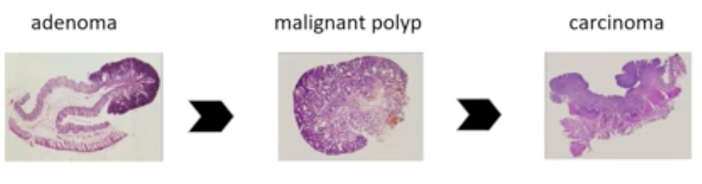 Adenoma → Malignant polyp → Carcinoma 