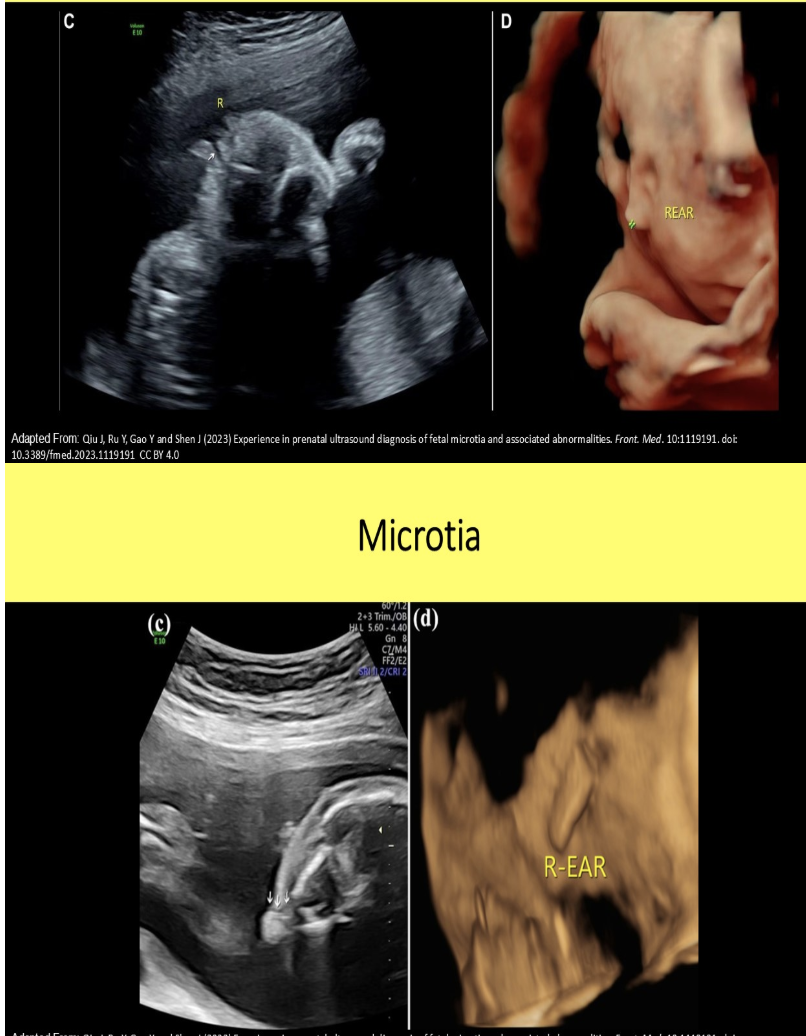 <p>microtia is a strong indicator of</p><p>a) triploidy</p><p>b) trisomy 21</p><p>c) trisomy 18</p><p>d) turner syndrome</p>