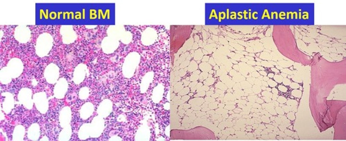 <p>Pancytopenia, hypocellular BM - mature cells look and function normally just low numbers, normo or macrocytic, relative lymphocytosis and neutropenia<br><br>-acquired or inherited<br>- acquired can be idiopathic</p>