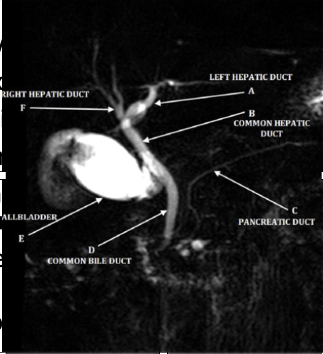 <p>-invasive, involves sedatives, radiation and more costly<br>-can cause pancreatitis, infection, bleeding<br>-<strong>diagnostic and therapeutic </strong>(stent, remove gallstones)<br>-<strong>gold standard for diagnosis of biliary obstruction</strong></p>