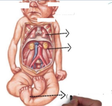 <ol><li><p>This image can be associated with what pathology? </p></li><li><p>What pathology can this condition be seen with?</p></li></ol><p></p>