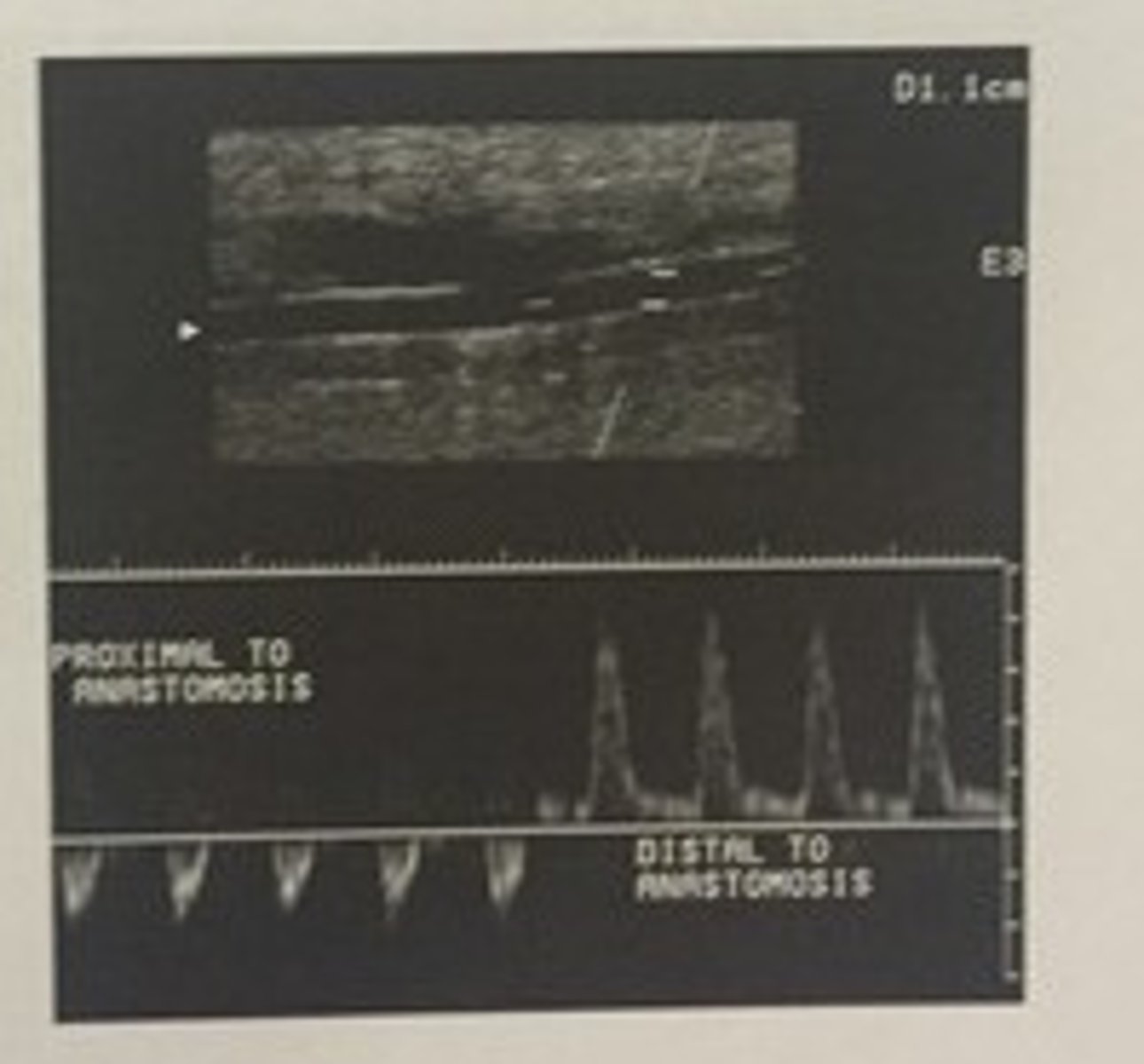 <p>465. (Peripheral arterial measurement techniques)</p><p>This doppler waveform was obtained in a posterior tibial artery by sweeping the doppler sample volume from above (prox) to a graft anastomisis to below (distal) to the graft anastomosis. There is retrograde flow above the bypass grafts anastomotic site. What is suggested by this finding?</p><p>a. AVF prox to graft anastom.</p><p>b. stenosis in the distal native artery</p><p>c. normal back flow up the native artery</p><p>d. stenosis in the graft</p>