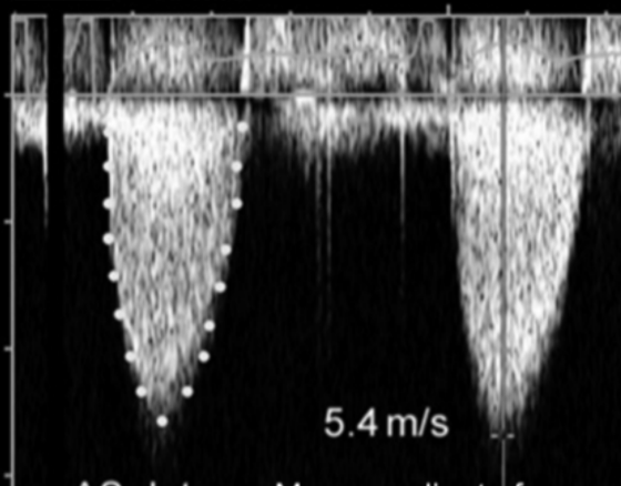 <p>A TVI tracing provides both mean</p><p>gradients and peak</p><p>velocity/gradient</p><p>Both are flow dependent</p><p>(Check prior echos for the best</p><p>view and highest velocity)</p>