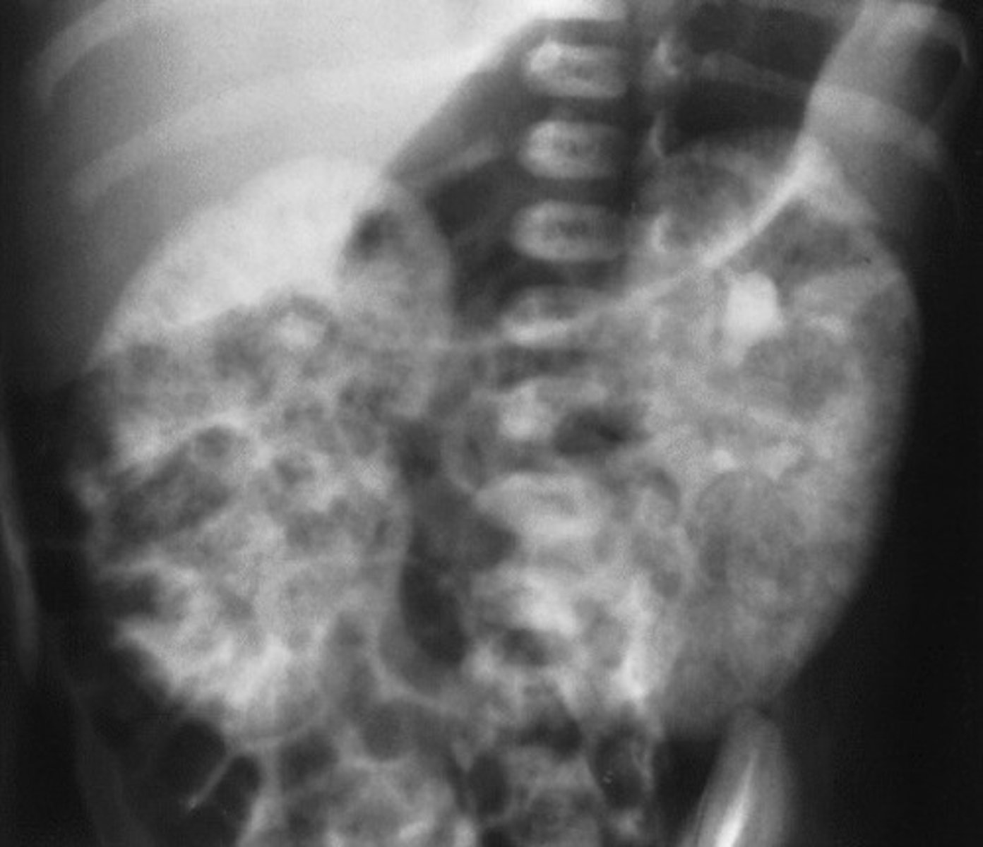 <p>What type of renal cyst is congenital?</p>