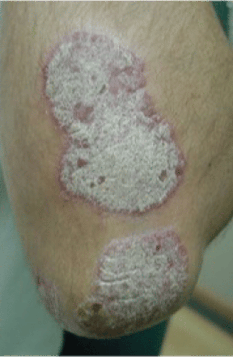 <p>A solid flat elevated lesion, usually &gt;1 cm</p><p>- Ex: Psoriasis</p>