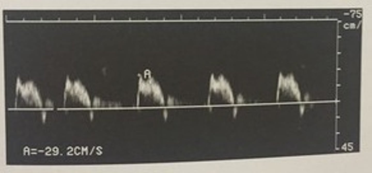 <p>428. (Peripheral arterial measurement techniques)</p><p>Which term can be used to describe this waveform?</p><p>a. triphasic</p><p>b. biphasic</p><p>c. tardus parvus</p><p>d. monophasic</p>