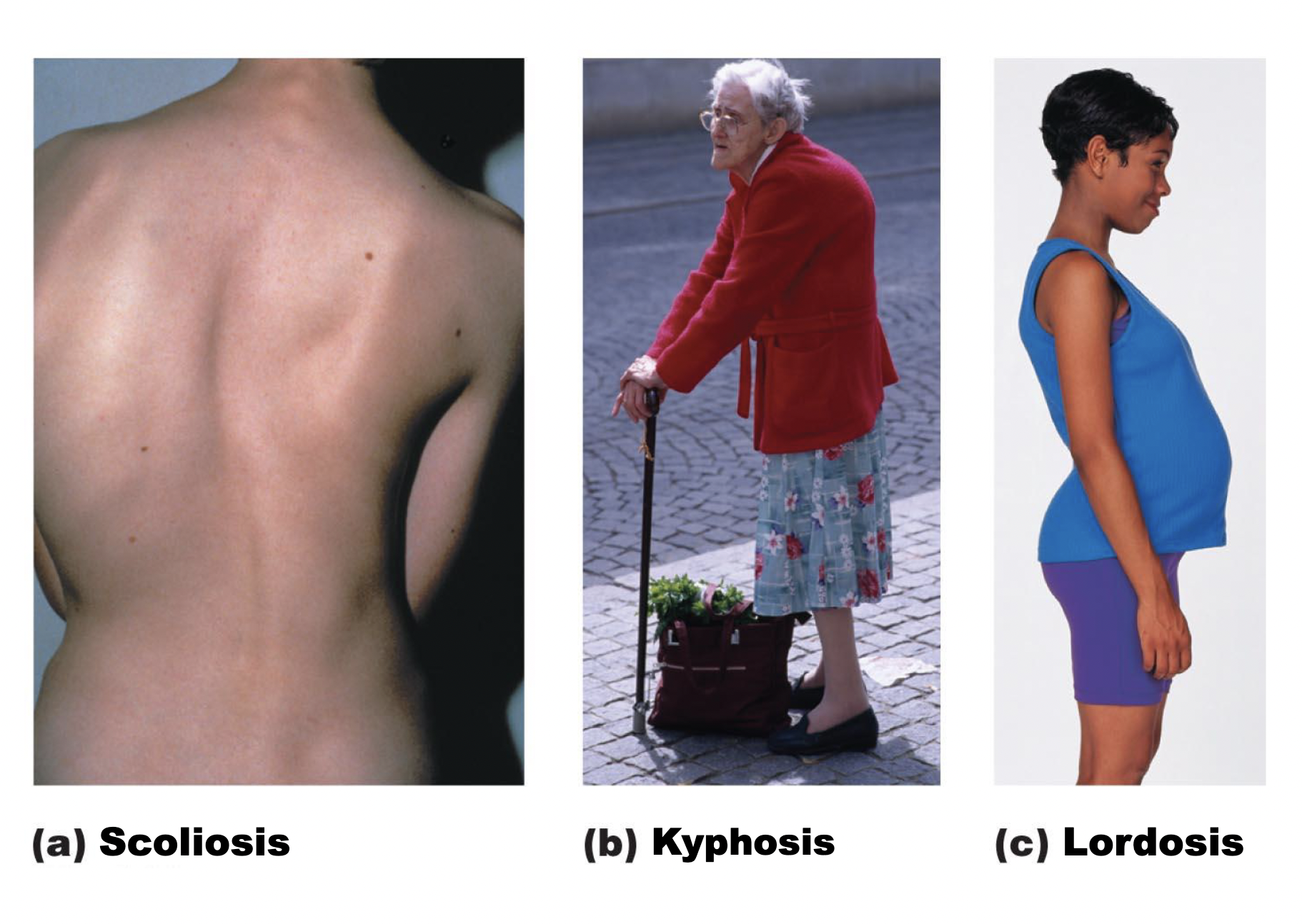 **scoliosis**