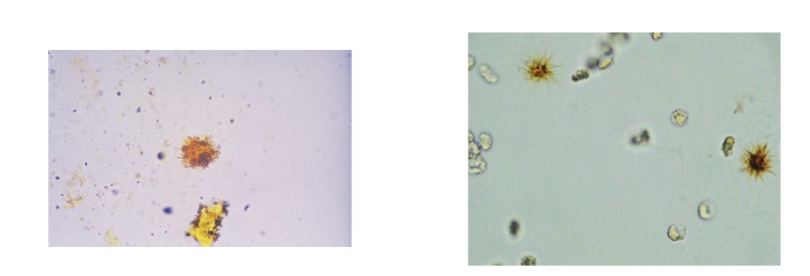 <p><span>Hepatic disorders</span></p><p><span>Clumped needles or granules</span></p><p><span>Characteristic bright yellow color</span></p><p><span>Viral hepatitis with tubular damage</span></p>