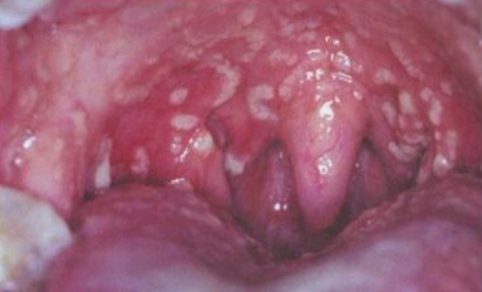 <p>yellowish, elevated pustules with erythematous oral mucosa, <strong>“snail track”</strong></p>