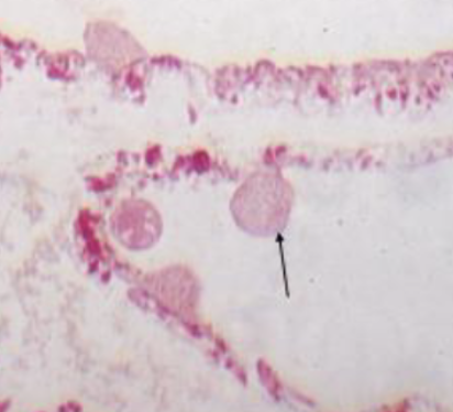 <p>What is the name of this structure and disease?</p>