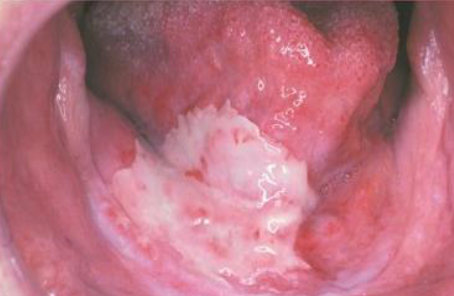 <p><strong>localized</strong> ulceration following cancer treatment </p>