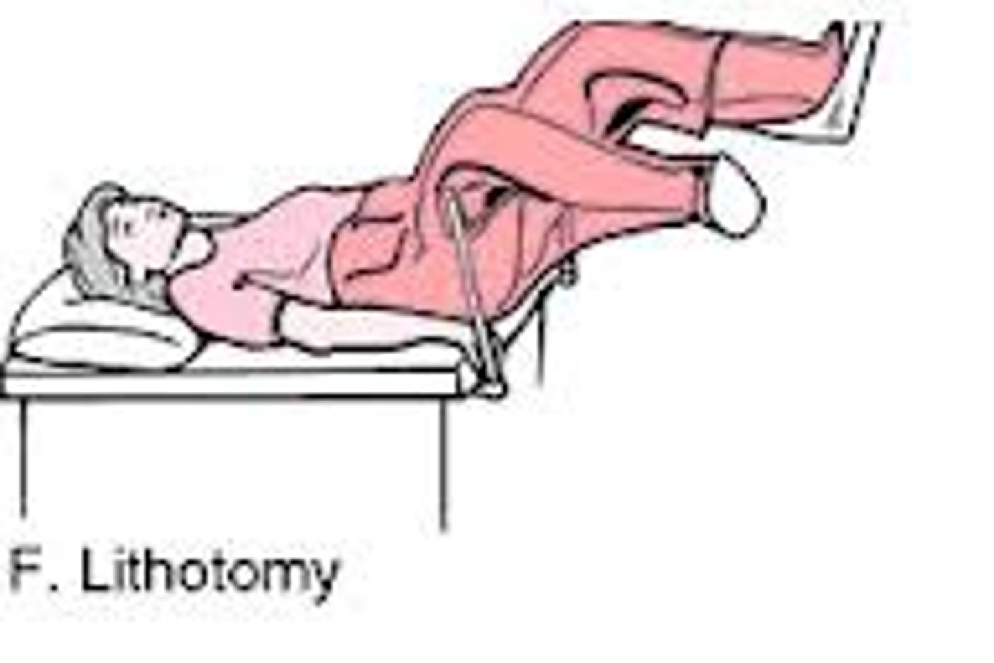 <p>A recumbent (supine) position with knees and hip flexed and thighs abducted and rotated externally, supported by ankle supports.</p>