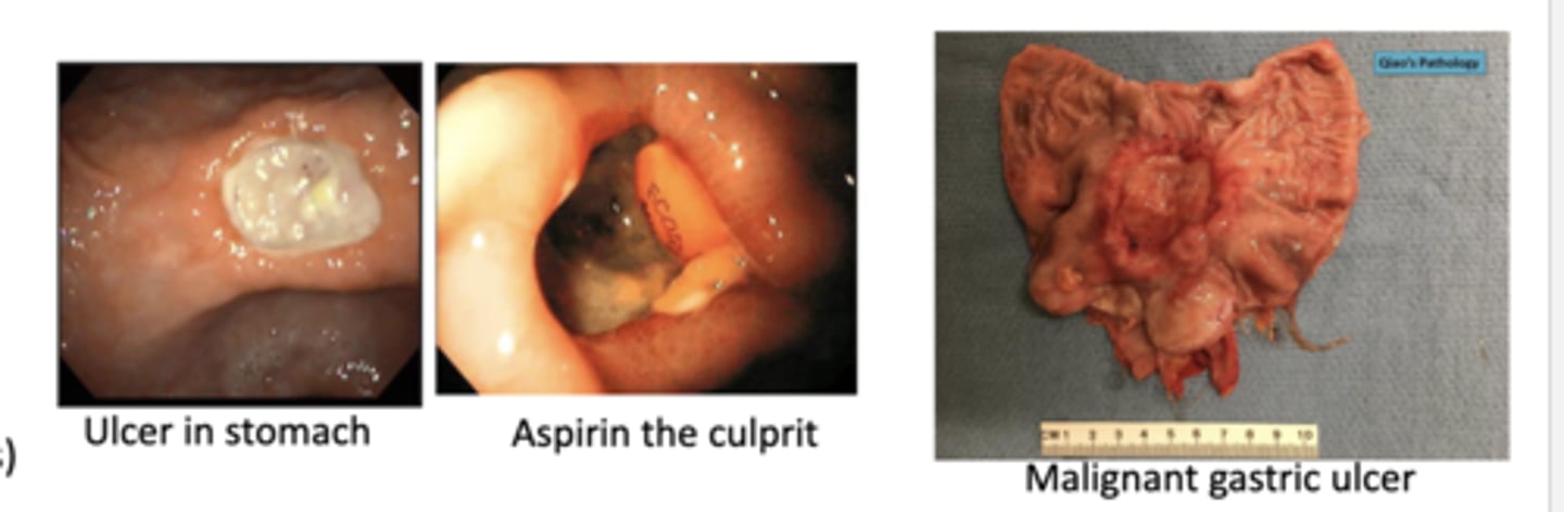 <p>-benign --&gt; have defined borders</p><p>-malignant ulcers--&gt; undefined borders</p>