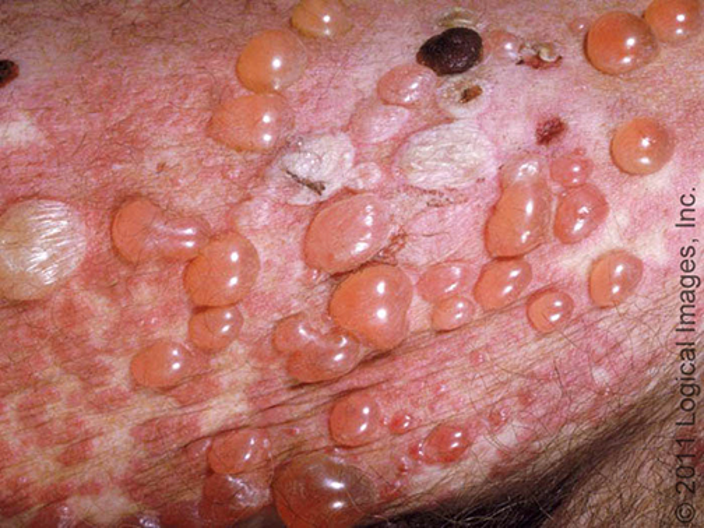 <p>Bullous Pemphigoid </p>