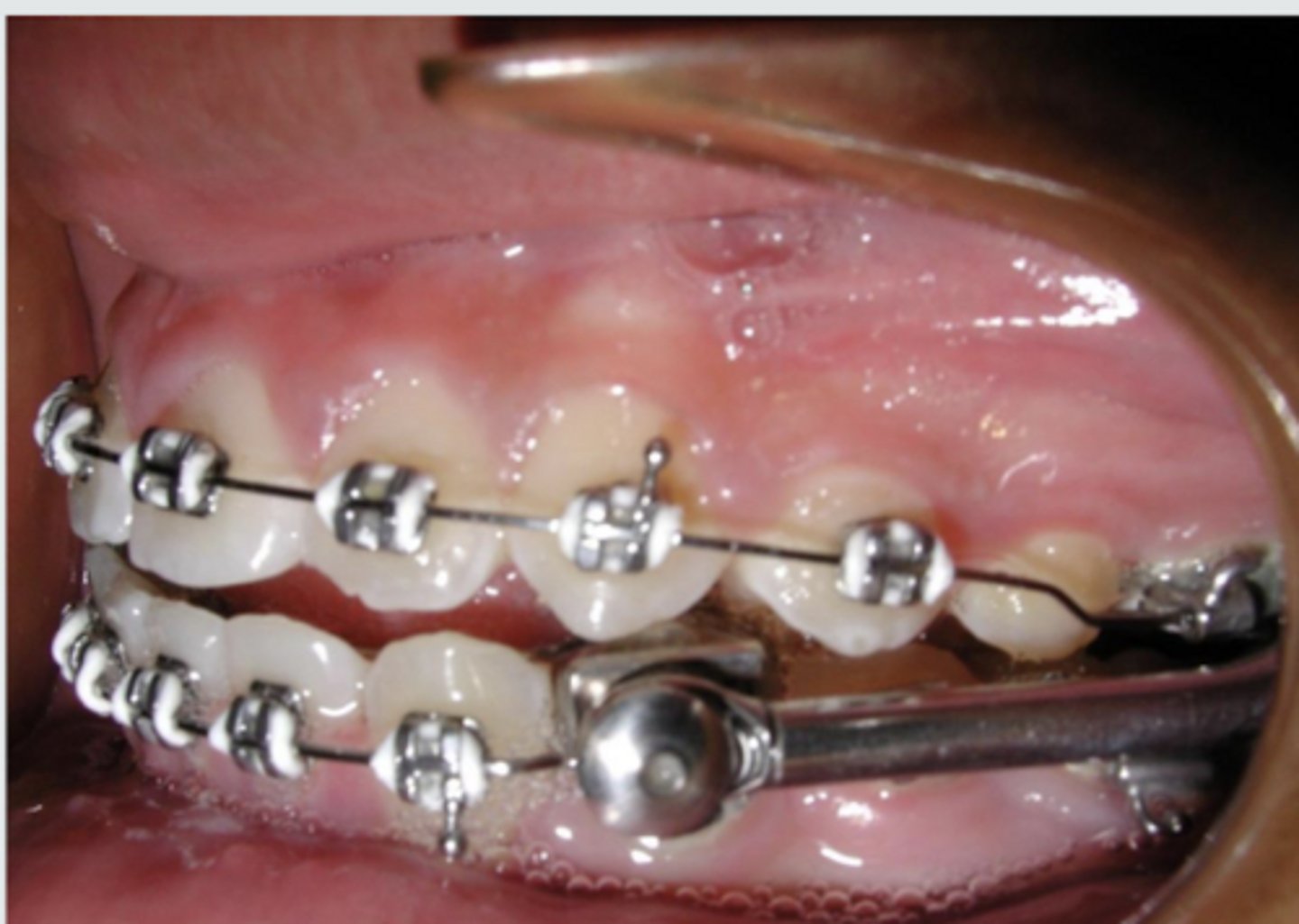 <p>Class II</p><p>Fixed</p><p>Functional</p>